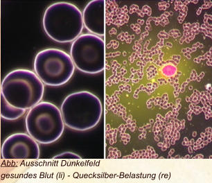 Abb: Ausschnitt Dunkelfeld gesundes Blut (li) - Quecksilber-Belastung (re)