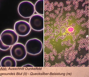 Abb: Ausschnitt Dunkelfeld gesundes Blut (li) - Quecksilber-Belastung (re)